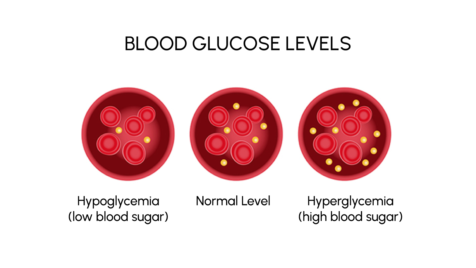 Figure 3. Blood glucose spectrum: hypoglycemia, normal, hyperglycemia.